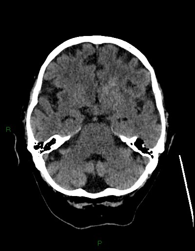 Cerebral metastases - ependymal and parenchymal (Radiopaedia 79877-93131 Axial non-contrast 21).jpg