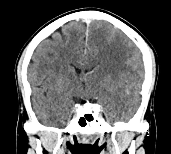 Cerebral metastases - testicular choriocarcinoma (Radiopaedia 84486-99855 D 29).jpg