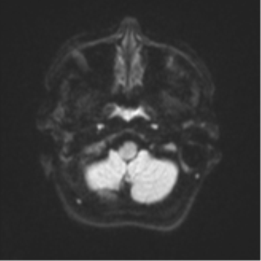 Cerebral metastases mimicking abscesses (Radiopaedia 45841-50131 Axial DWI 33).png