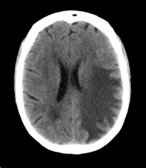 File:Cerebral metastasis (Radiopaedia 46744-51247 Axial non-contrast 19).png