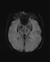 File:Cerebral metastasis (Radiopaedia 46744-51248 Axial SWI 14).png