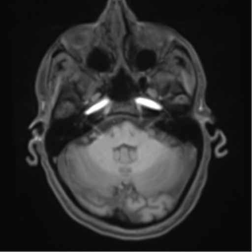 Cerebral metastasis - melanoma (Radiopaedia 54718-60954 Axial T1 14).png
