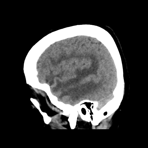 Cerebral metastasis to basal ganglia (Radiopaedia 81568-95412 E 15).png