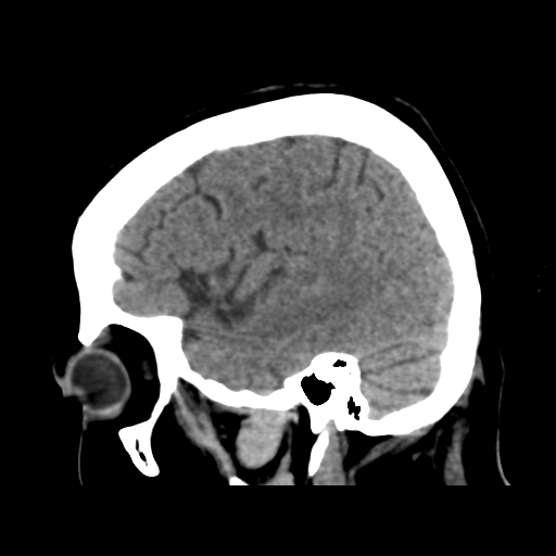 Cerebral metastasis to basal ganglia (Radiopaedia 81568-95412 E 46).png