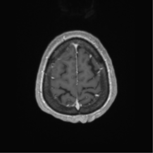 Cerebral metastasis to basal ganglia (Radiopaedia 81568-95413 Axial T1 C+ 66).png