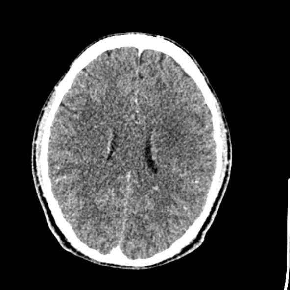 Cerebral toxoplasmosis (Radiopaedia 53993-60131 Axial C+ delayed 46).jpg