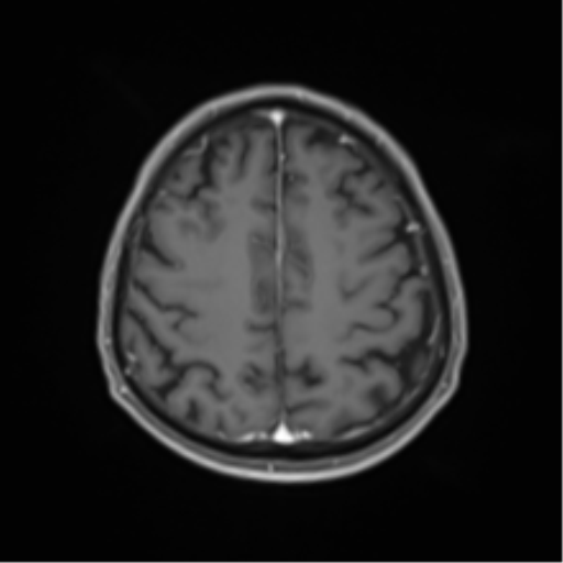 Cerebral toxoplasmosis (Radiopaedia 54575-60804 Axial T1 C+ 42).png