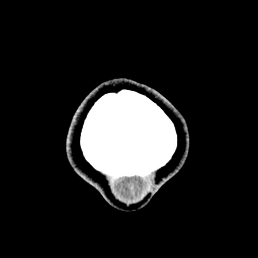 Cerebral tuberculosis with dural sinus invasion (Radiopaedia 60353-68018 Axial non-contrast 65).jpg