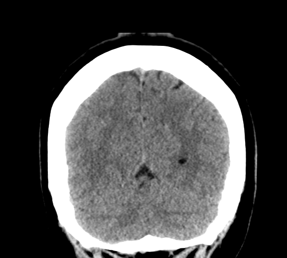File:Cerebral venous infarct related to dural venous sinus thromboses (Radiopaedia 35292-36804 Coronal non-contrast 29).png