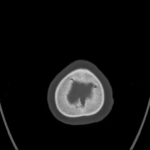 Cerebral venous infarction with hemorrhage (Radiopaedia 65343-74381 Axial bone window 189).jpg