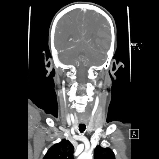Cerebral venous infarction with hemorrhage (Radiopaedia 65343-74396 B 196).jpg