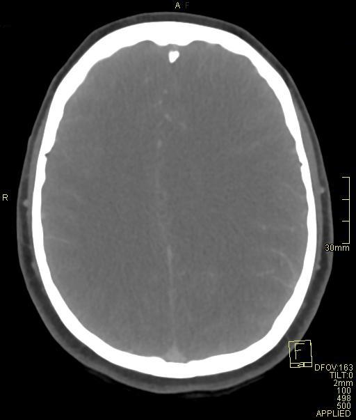 Cerebral venous sinus thrombosis (Radiopaedia 91329-108965 Axial venogram 53).jpg