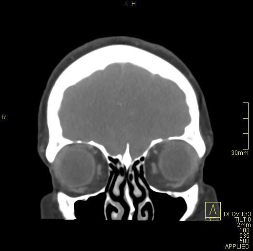 Cerebral venous sinus thrombosis (Radiopaedia 91329-108965 Coronal venogram 16).jpg