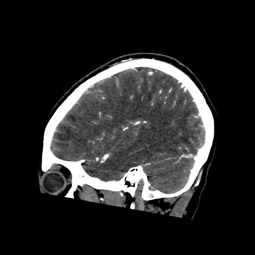 File:Cerebral venous throbmosis - hemorrhagic venous infarction (Radiopaedia 87318-103613 Sagittal CT venogram 35).jpg