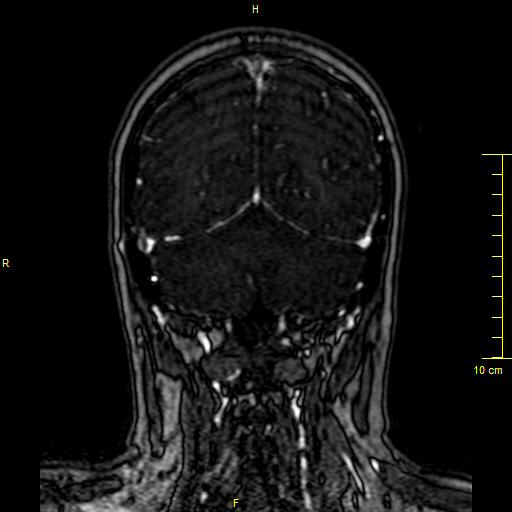 Cerebral venous thrombosis (Radiopaedia 23288-23351 MRV 128).JPG
