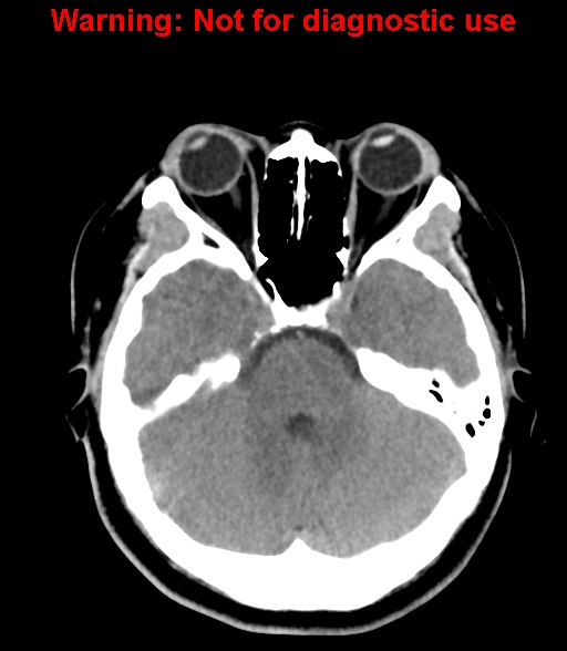 File:Cerebral venous thrombosis (Radiopaedia 37224-38992 Axial non-contrast 9).jpg