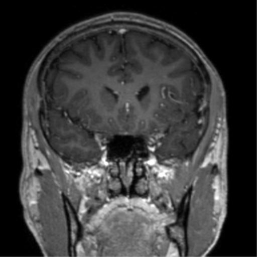 Cerebral venous thrombosis (Radiopaedia 38392-40469 Coronal T1 C+ 61).png