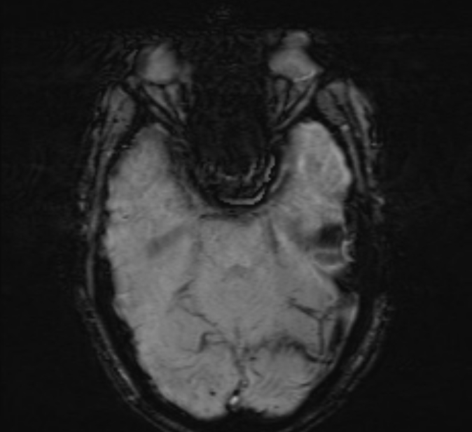 Cerebral venous thrombosis (Radiopaedia 71207-81504 Axial SWI 16).jpg