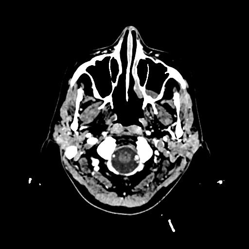 Cerebral venous thrombosis with venous hemorrhagic infarct (Radiopaedia 90354-107660 Axial with contrast 10).jpg