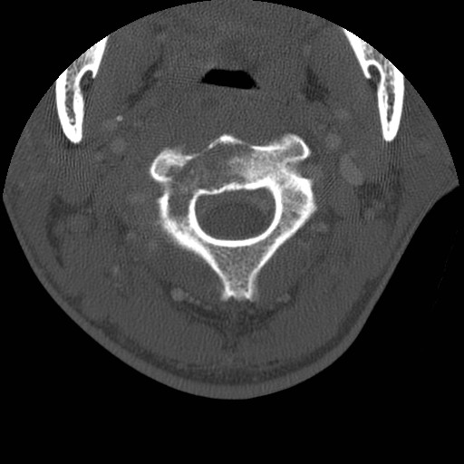 Cervical Pott disease (Radiopaedia 20374-20286 Axial bone window 38).jpg