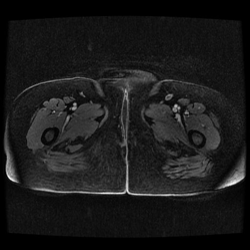 File:Cervical carcinoma (Radiopaedia 70924-81132 Axial T1 C+ fat sat 187).jpg