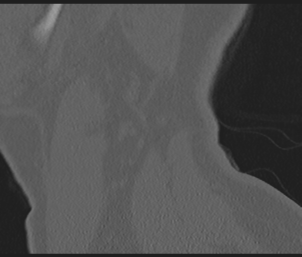 Cervical disc replacement (Radiopaedia 44025-47541 Sagittal bone window 77).png