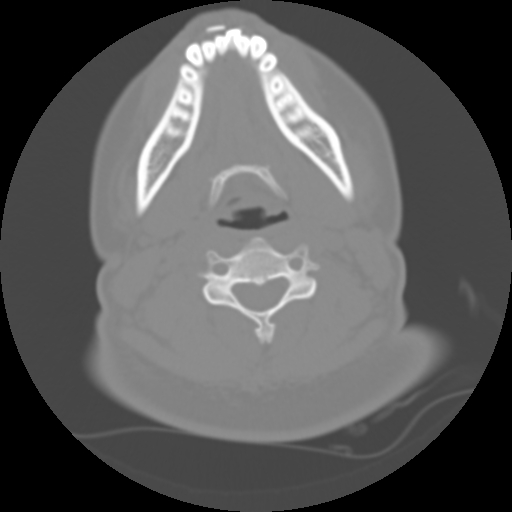 Cervical rib (Radiopaedia 71110-81363 Axial non-contrast 30).jpg
