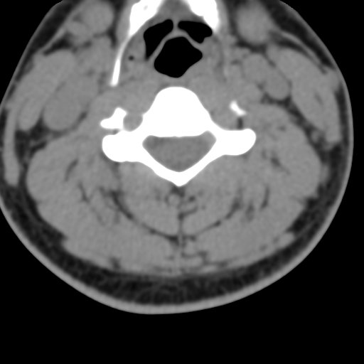 Cervical schwannoma (Radiopaedia 57979-64974 Axial non-contrast 32).png