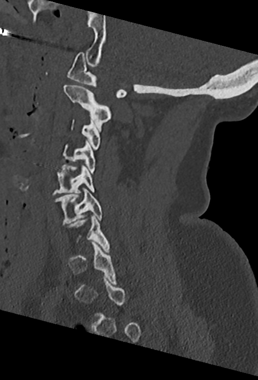 Cervical spine ACDF loosening (Radiopaedia 48998-54070 Sagittal bone window 35).png