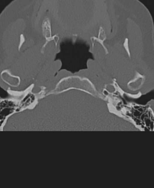 Cervical spine ACDF loosening (Radiopaedia 48998-54071 Axial bone window 5).png