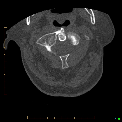 Cervical spine fracture - ankylosing spondylitis (Radiopaedia 76835-88706 Axial bone window 38).jpg
