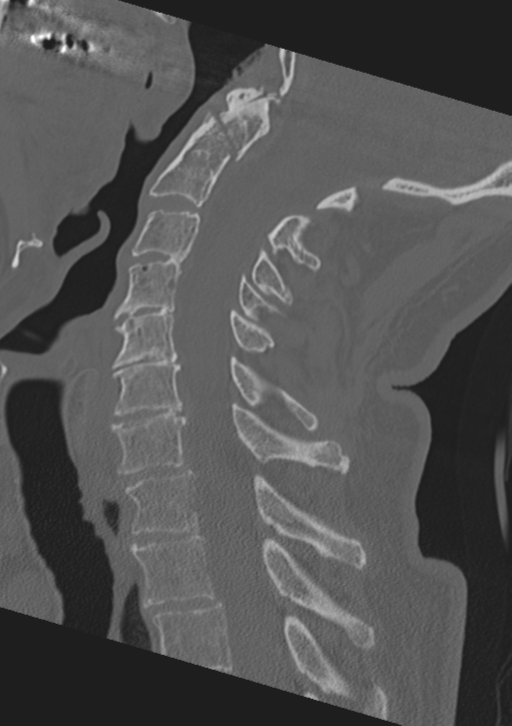 Cervical spine fractures with vertebral artery dissection (Radiopaedia 53296-59268 Sagittal bone window 35).png