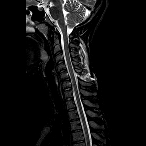 File:Cervical spine posterior ligamentous complex rupture (Radiopaedia 63486-72103 Sagittal STIR 7).jpg