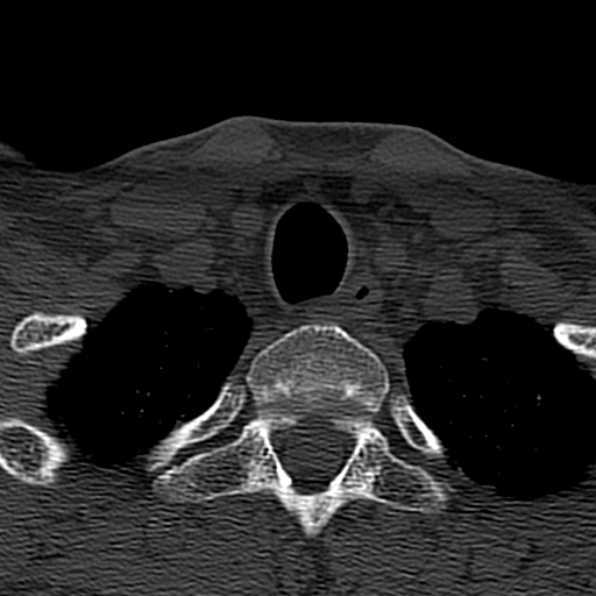 Cervical spondylodiscitis (Radiopaedia 28057-29489 Axial bone window 74).jpg