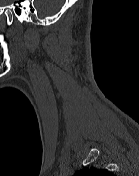 Cervical spondylodiscitis (Radiopaedia 28057-29489 Sagittal bone window 58).jpg