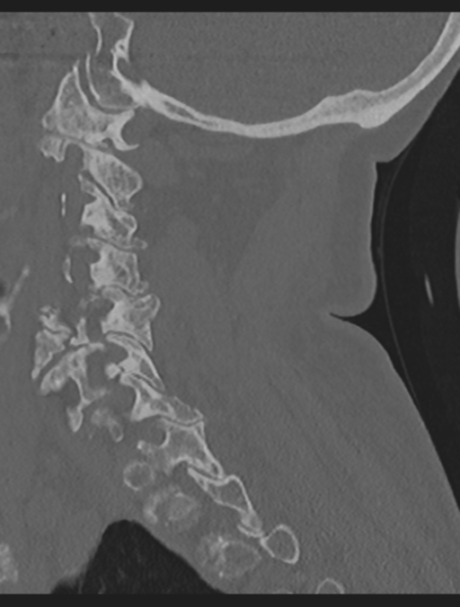 Cervical spondylolysis (Radiopaedia 49616-54811 Sagittal bone window 27).png