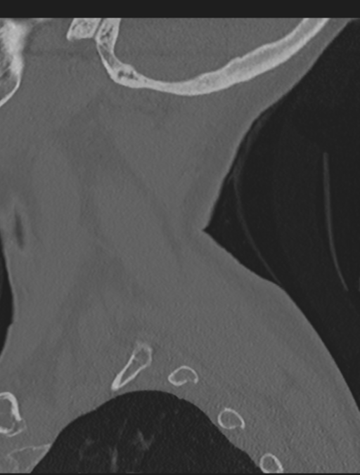 Cervical spondylolysis (Radiopaedia 49616-54811 Sagittal bone window 8).png