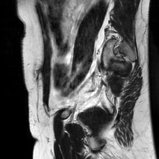 File:Cesarian section scar endometriosis (Radiopaedia 66520-75799 Sagittal T2 10).jpg
