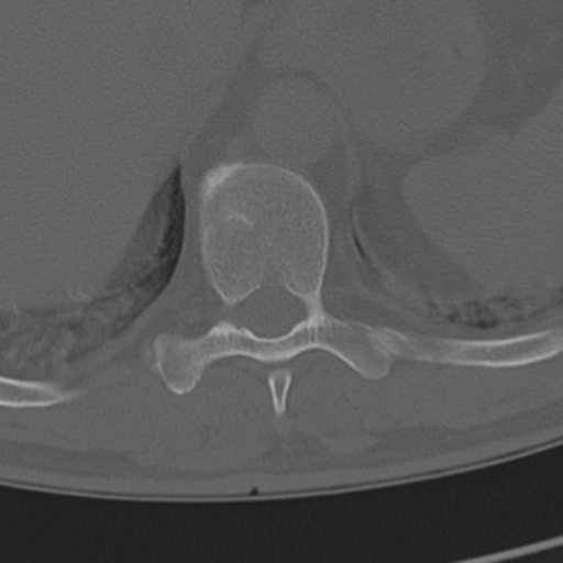 Chance fracture (Radiopaedia 33854-35020 Axial bone window 71).png