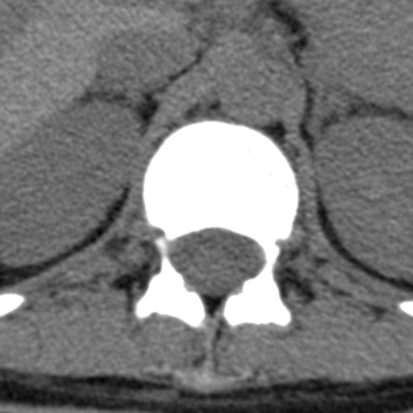 File:Chance fracture (Radiopaedia 36521-38081 Axial non-contrast 63).jpg