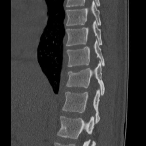 Chance fracture (Radiopaedia 36521-38081 Sagittal bone window 22).jpg