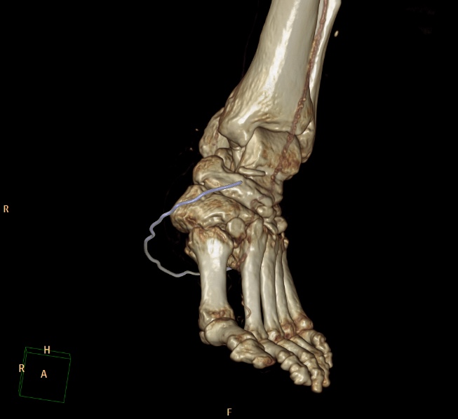File:Charcot joint (Radiopaedia 36629-38194 3D bone window 3).jpg