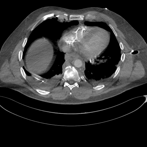 File:Chest multitrauma - aortic injury (Radiopaedia 34708-36147 A 207).png