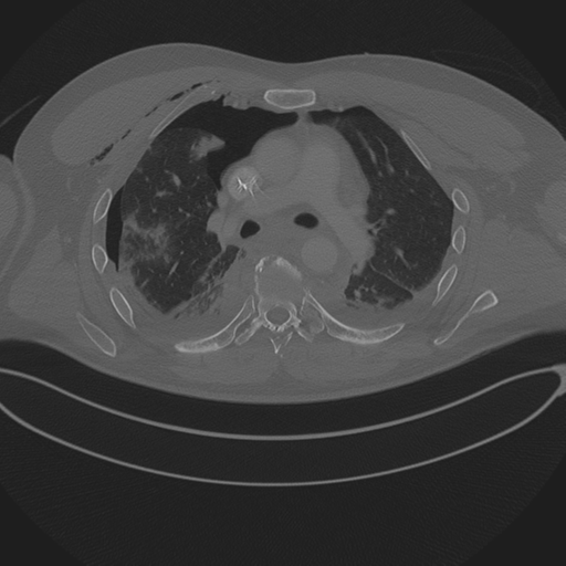 Chest multitrauma - aortic injury (Radiopaedia 34708-36147 Axial bone window 129).png