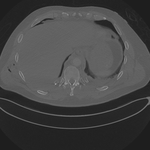 Chest multitrauma - aortic injury (Radiopaedia 34708-36147 Axial bone window 249).png