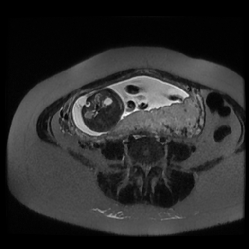 Chiari II malformation - fetal MRI (Radiopaedia 68099-77581 Axial T2-SSFSE 22).jpg