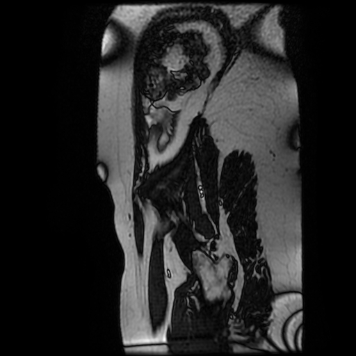 Chiari II malformation - fetal MRI (Radiopaedia 68099-77581 Sagittal Fiesta 2).jpg