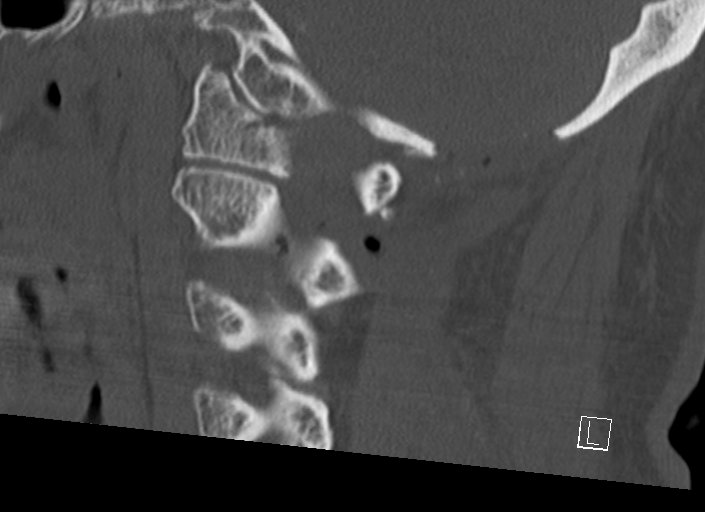Chiari I malformation with a symptomatic syrinx of the posterolateral medulla oblongata (Radiopaedia 42573-45707 A 23).jpg