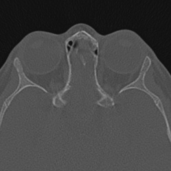 Choanal atresia (Radiopaedia 88525-105975 Axial bone window 100).jpg