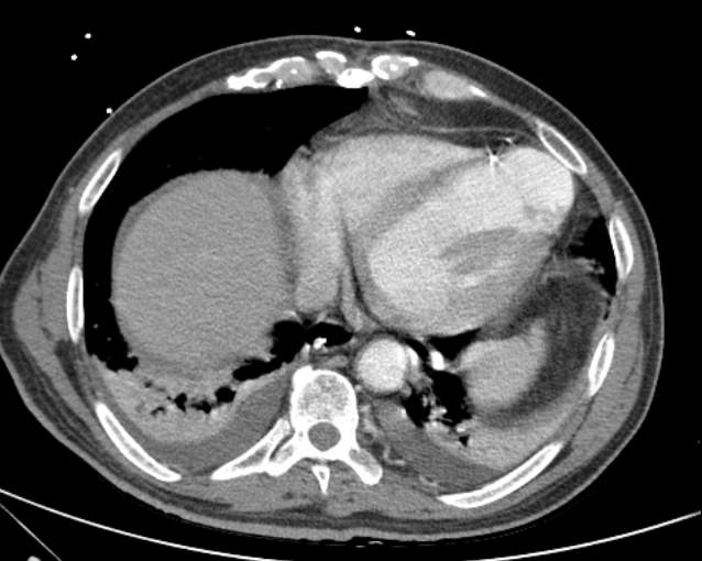 Cholecystitis - perforated gallbladder (Radiopaedia 57038-63916 A 10).jpg